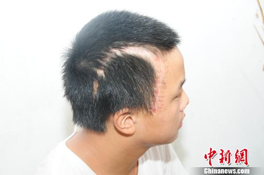 14歲男孩車禍重傷 因無力支付高額手術(shù)費父拒認(rèn)子
